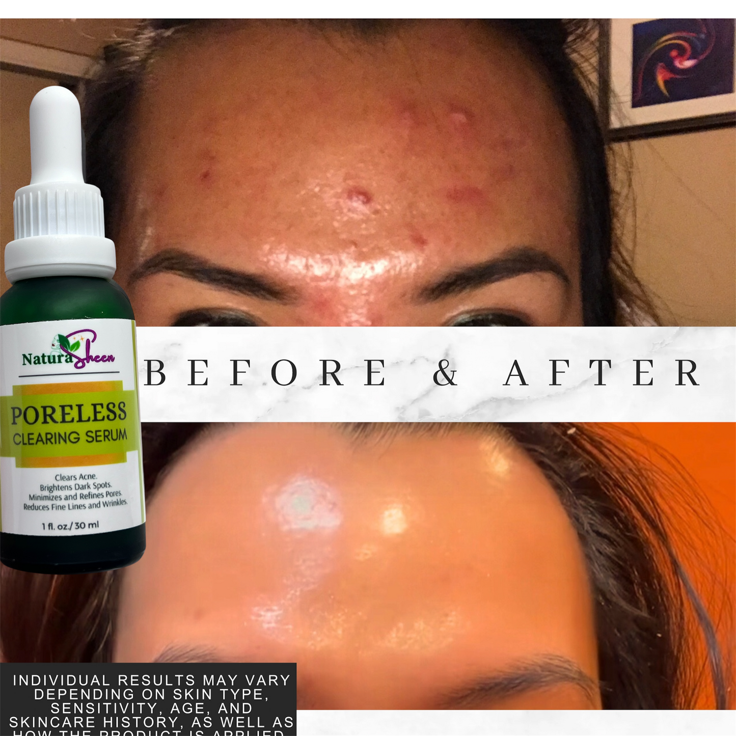 Clear Skin Duo for Acne, Dark Spot, Dull Skin, Large Pores, Fine Lines