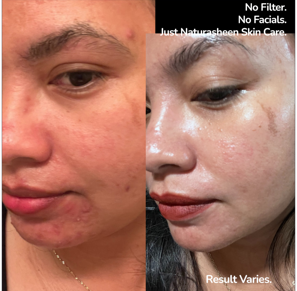 Clear Skin Duo for Acne, Dark Spot, Dull Skin, Large Pores, Fine Lines