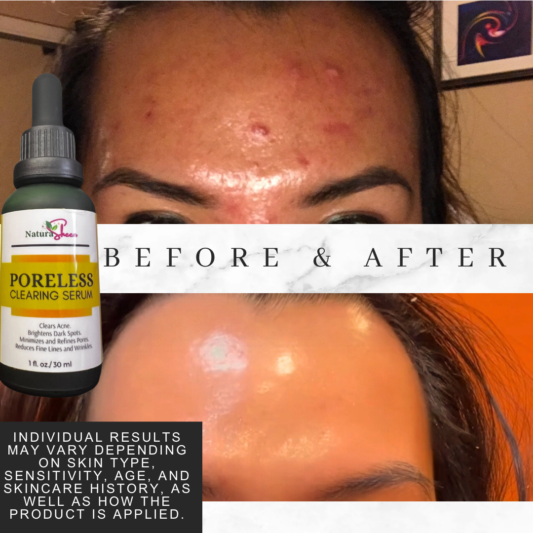 PORELESS CLEARING SERUM 1oz/30ml
(Tighten Skin, Shrink Pores, Clears Acne, helps remove dark spots and blemishes, reduce fine lines and wrinkles)